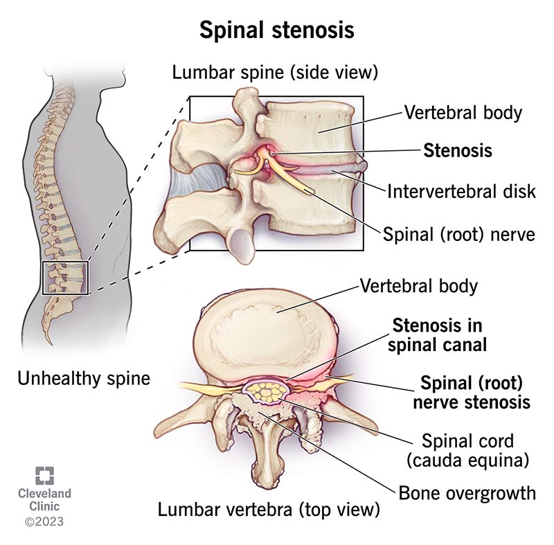 LumbarSpinalStenosis.jpg